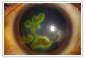 Archivo:Queratopatía LUT.jpg