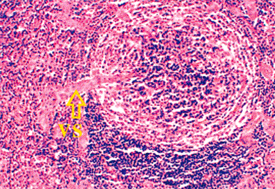 Anemia hemolítica autoinmunitaria idiopática - EcuRed