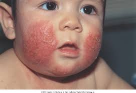 Archivo:Dermatenbebe.jpg