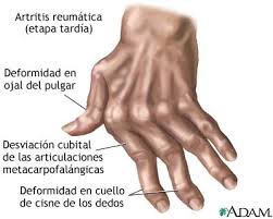Artritis reumatoideaaa.jpg