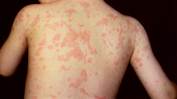 Sindrome de Blau - EcuRed