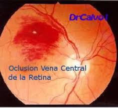 Oclusión de la vena central de la retina.jpg