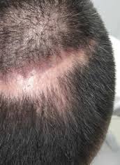 ALOPECIA CICATRICIAL.jpg