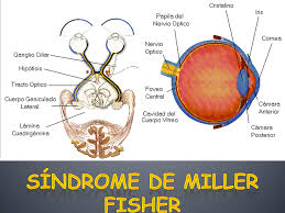 Síndrome de Miller-Fisher.jpeg