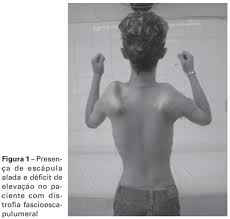 Distrofia de cintura ok.jpeg