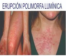 Erupci n Polimorfa Lum nica EcuRed erupci-n-polimorfa-lum-nica-ecured