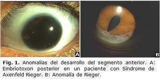 Archivo:Anomalia de rieger.jpg
