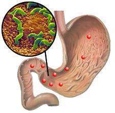 Duodenitis.jpg