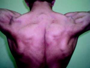 Archivo:Myotonia-Congenita-Picture-300x225.jpg