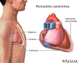 Pericarditis crónica.jpg