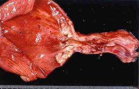 Cáncer de uretra

Formación de células cancerígenas o malignas en los tejidos que comprenden la uretra, el tubo que transport