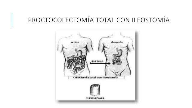 Proctocolectomía Total Con Ileostomía Terminal