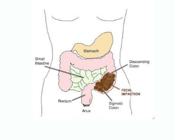 Archivo:Fecaloma .png