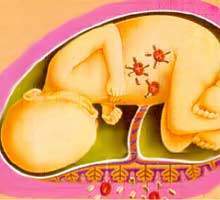 Hidropesía Fetal.jpg