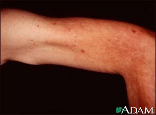Archivo:Telangiectasias-upper-arm.jpg