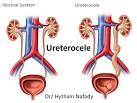 Ureterocele.jpg