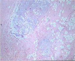 Tejido del hamartoma.jpg