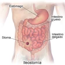 Ileostomia.jpg