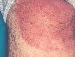 Úlcera fagedénica tropical.jpeg