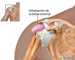 Bursitis del hombro.jpg