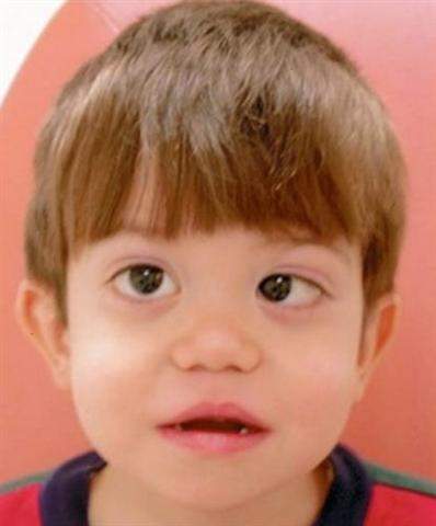 Archivo:Síndrome-de-Stickler 2 (Small).jpg