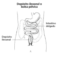 Reservorio ileoanal.gif