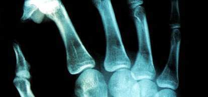 Archivo:Tumores óseos2.jpg