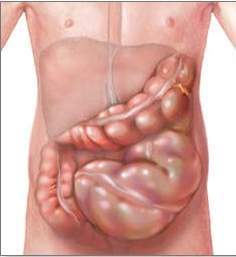 Megacolon toxico.jpg
