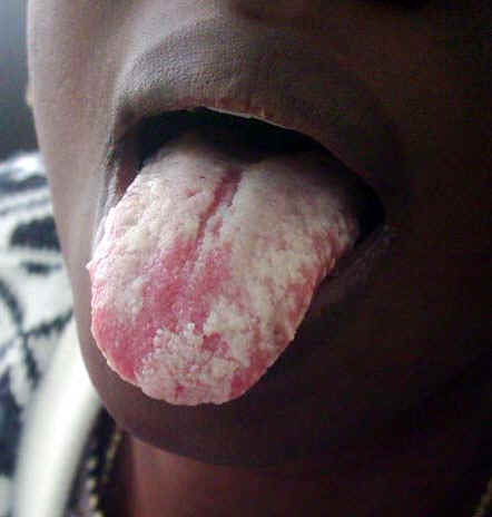 Archivo:Aids oral candidiasis ojoh.jpg