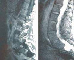 Sacrolumbalgia Imagen.jpg