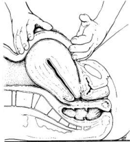 Sepsis puerperal.JPG