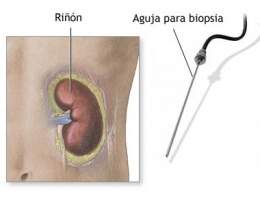Biopsia renal.jpg