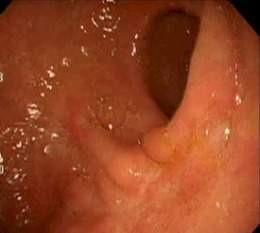 Imagen videoendoscopica.jpg