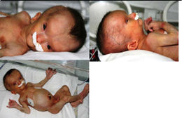 Progeroides neonatal.jpg