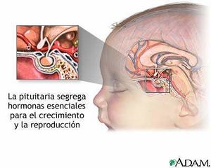 Síndrome de Silla Turca vacía.jpg