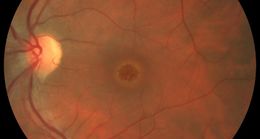 Macular-hole-I-718x384.jpg