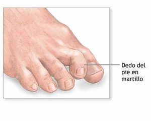 Dedo-martillo.jpg