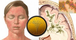 Leucoencefalopatia multifocal progresiva.JPG
