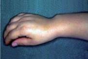 Madelung Muñeca.jpg