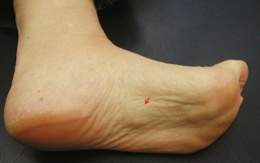 Fibromatosis plantar.jpg