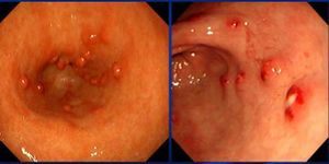 Gastritis cronica.jpg