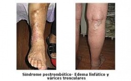 Linfangitis2.jpeg
