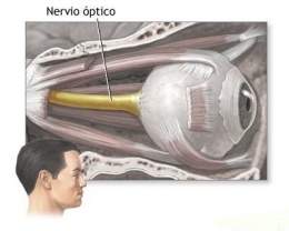 Atrofía Óptica1.jpg