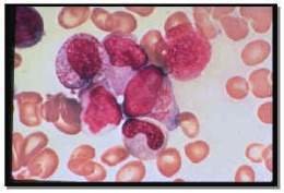 Leucemia 2.jpg