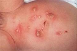 200px-Impetigo ampolloso (Small).jpg