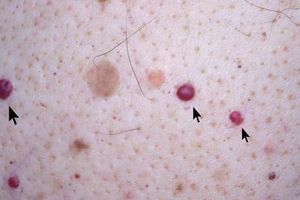 Hemangioma cereza-765x510.jpg