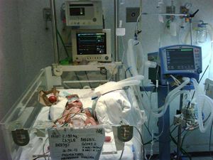 Hipert pulm res recién nacido 2.jpg