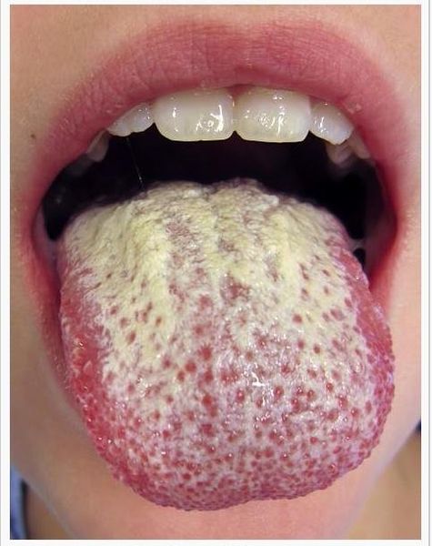 Archivo:Candidiasis bucal mujer.jpg