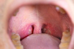 Img uvula inflamada causas y tratamiento 18958 600.jpg