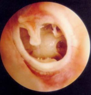 Otitis media crónica.jpg